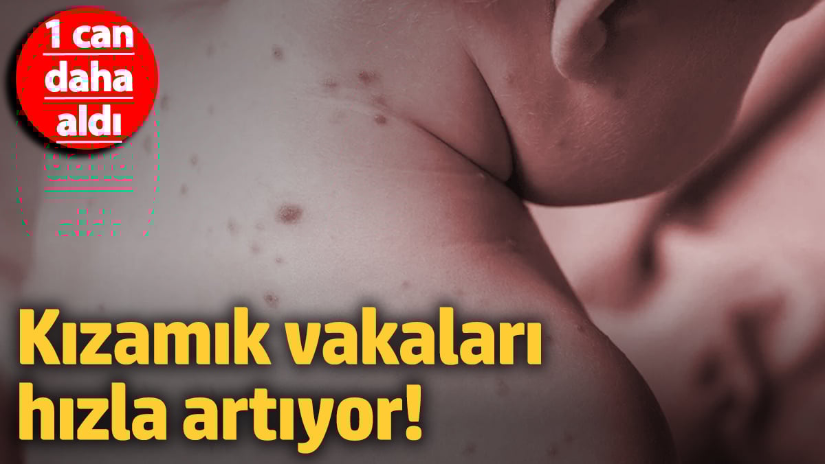 Kızamık olayları süratle artıyor! 1 can daha aldı